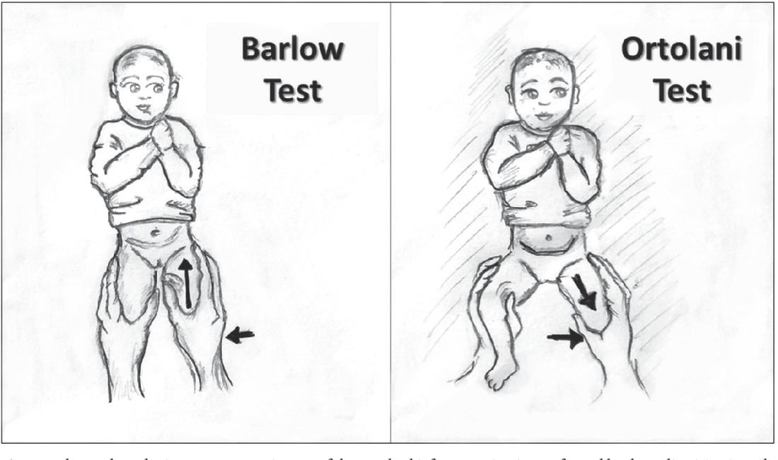 what-is-the-barlow-test-and-how-is-it-performed-heal-cure