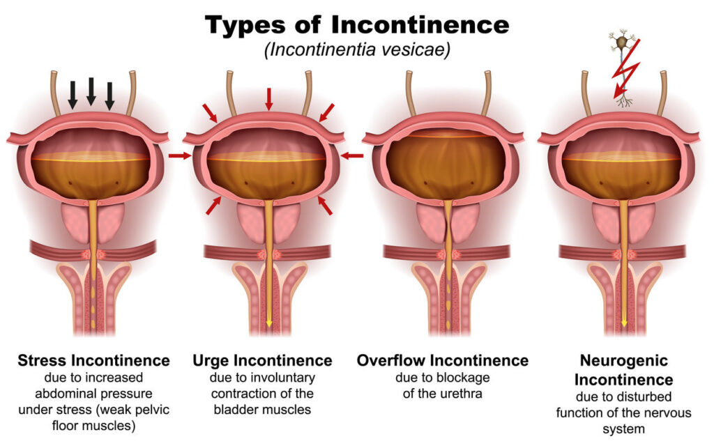 can-incontinence-be-cured-2024-guide-heal-cure